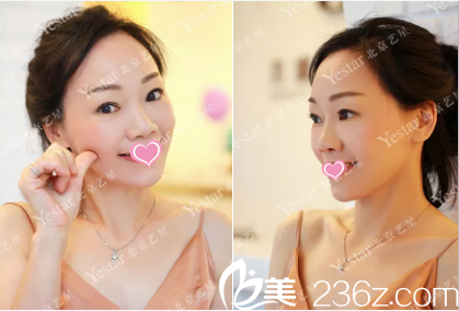 連凱峰面部脂肪填充2月效果