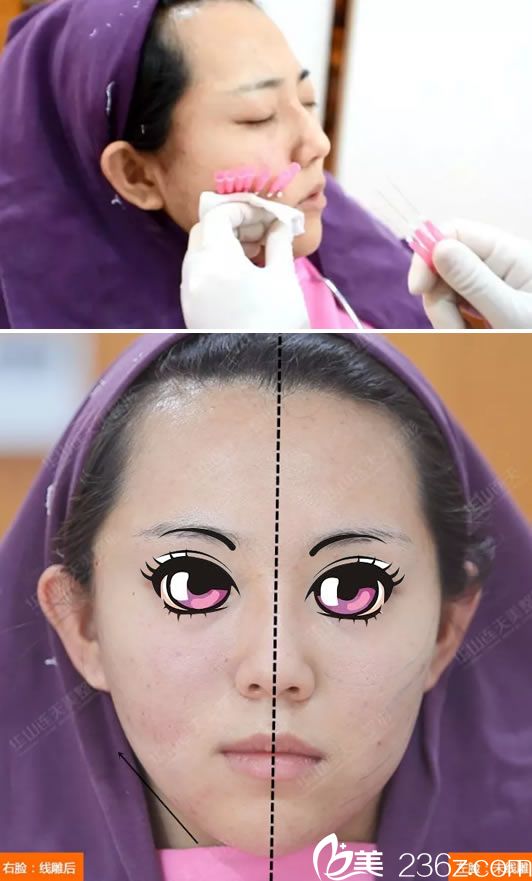 線雕手術(shù)過程和做完半張臉效果