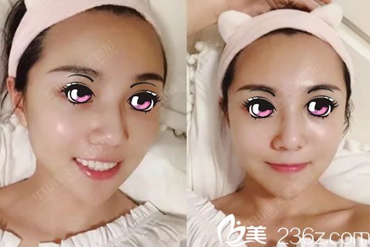 線雕和注射玻尿酸2天恢復(fù)效果