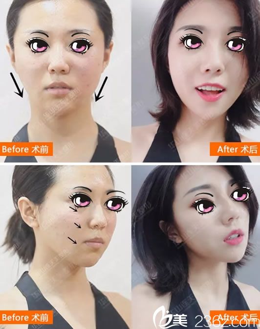 連天美<!--<i data=20240703-sp></i>-->線雕案例對比圖