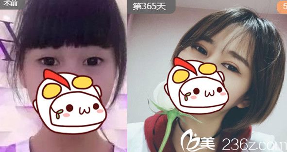 安徽合肥劉冷怎么樣？附劉冷雙眼皮整形案例對比圖