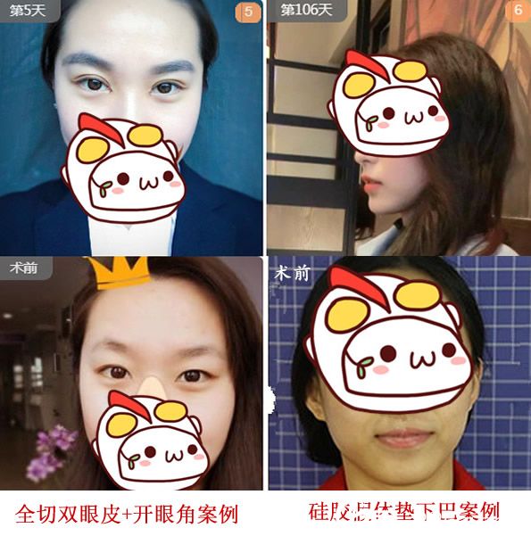 安徽合肥韓美閆品行雙眼皮案例+硅膠假體隆下巴案例