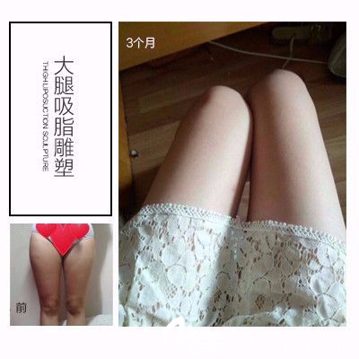 深圳美萊郭杰做的大腿吸脂<span style= 深圳美萊郭杰做的大腿吸脂<span style=