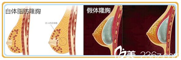 隆胸手術(shù)示意圖 隆胸手術(shù)示意圖