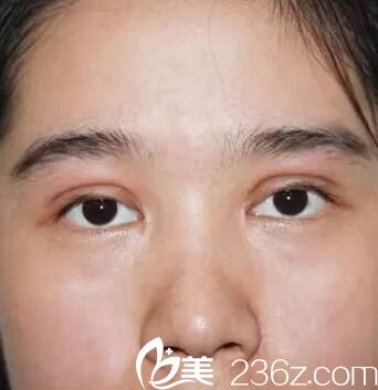 南寧華美雙眼皮術(shù)后第4天 南寧華美雙眼皮術(shù)后第4天