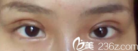 南寧華美雙眼皮術(shù)后第1天 南寧華美雙眼皮術(shù)后第1天