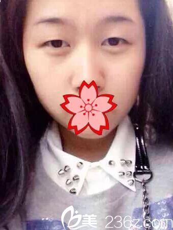 南寧華美雙眼皮手前 南寧華美雙眼皮手前