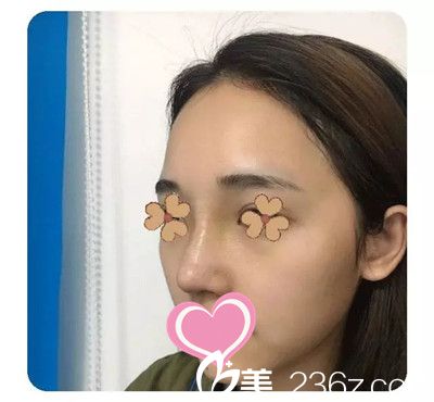 假體隆鼻后一個(gè)月效果