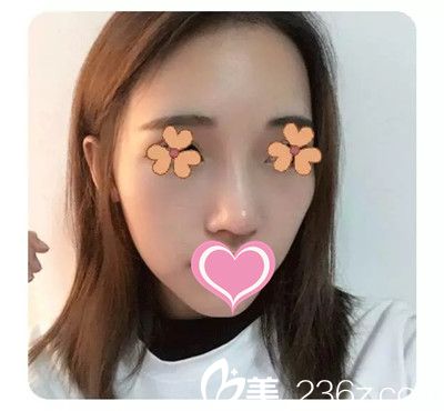 李迎春醫(yī)生隆鼻案例