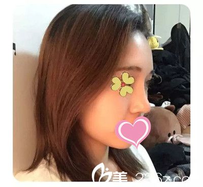 隆鼻后三個(gè)月恢復(fù)效果