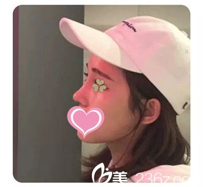 李迎春給我做隆鼻手術(shù)四個(gè)月了