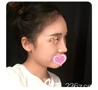 真后悔沒有早點(diǎn)找九江臺美整形李英春醫(yī)生做隆鼻，分享下半年后的蛻變效果吧