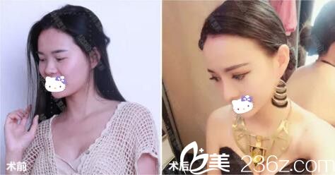 ARSMO軟骨鼻前后對(duì)比