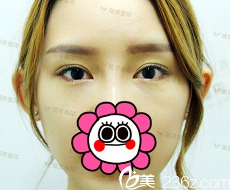 <!--<i data=20240703-sp></i>-->做下眼瞼下至手術(shù)前 <!--<i data=20240703-sp></i>-->做下眼瞼下至手術(shù)前