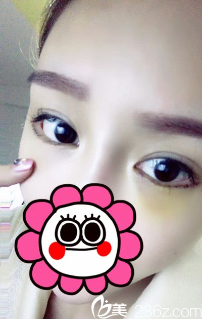 <!--<i data=20240703-sp></i>-->下眼瞼下至手術(shù)后4天 <!--<i data=20240703-sp></i>-->下眼瞼下至手術(shù)后4天