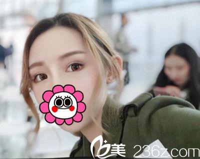 <!--<i data=20240703-sp></i>-->下眼瞼下至手術(shù)后9天 <!--<i data=20240703-sp></i>-->下眼瞼下至手術(shù)后9天