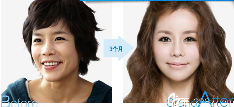 柳相旭院長(zhǎng)雙顎手術(shù)