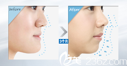 柳相旭院長(zhǎng)雙顎手術(shù)前后對(duì)比