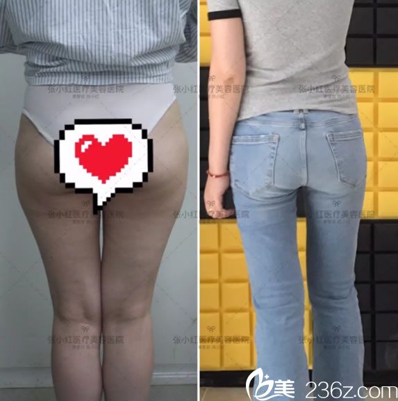 在義烏張小紅做完大腿吸脂25天后 在義烏張小紅做完大腿吸脂25天后