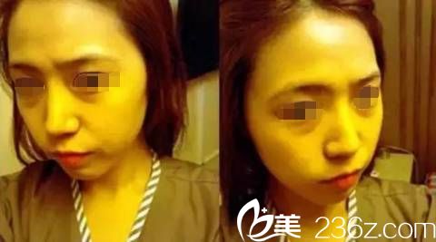 玻尿酸注射填充面部