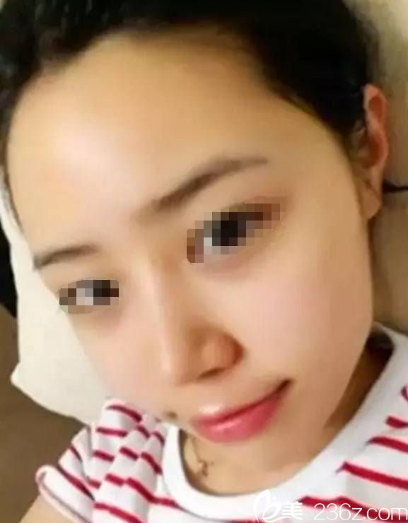 注射玻尿酸填充術后兩天