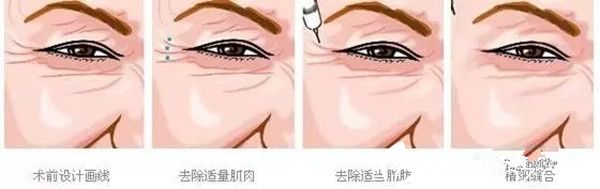 瘦臉除皺除皺 瘦臉除皺除皺