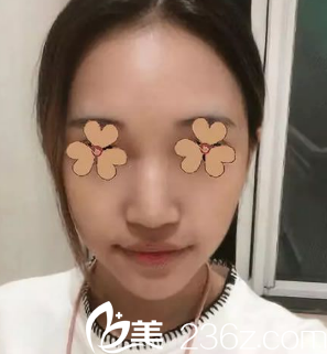 安康蝶姿美容門診部做雙眼皮比隆鼻多 安康蝶姿美容門診部做雙眼皮比隆鼻多