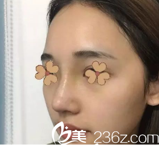 安康蝶姿美容門診部隆鼻第20天的樣子 安康蝶姿美容門診部隆鼻第20天的樣子