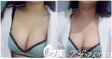 北京美萊自體脂肪隆胸3月效果 北京美萊自體脂肪隆胸3月效果