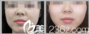 韓國Stanley皮膚科脂肪填充法令紋效果 韓國Stanley皮膚科脂肪填充法令紋效果