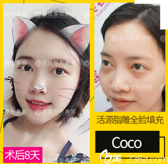 廣州荔醫(yī)整形美容醫(yī)院鄒順祿主任全臉脂肪填充案例 廣州荔醫(yī)整形美容醫(yī)院鄒順祿主任全臉脂肪填充案例