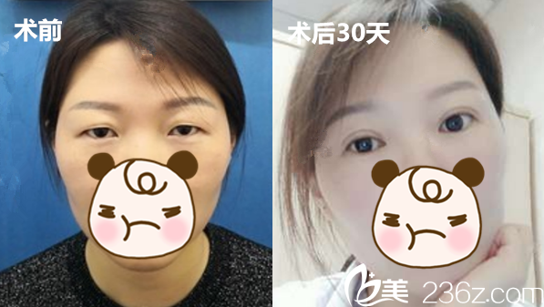 合肥壹美尚李昌斌全切雙眼皮案例前后效果對比圖