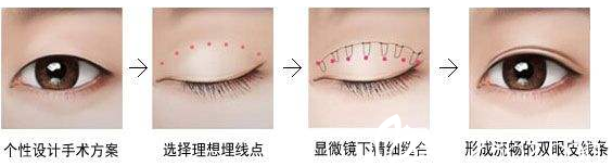 濟源<!--<i data=20240703-sp></i>-->萍埋線雙眼皮過程