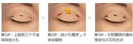 濟源<!--<i data=20240703-sp></i>-->萍韓式雙眼皮過程