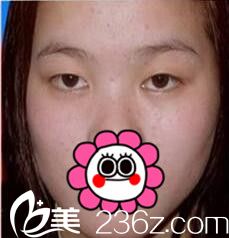 濟源<!--<i data=20240703-sp></i>-->萍雙眼皮術前案例