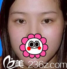 求問(wèn)濟(jì)源萍做雙眼皮怎么樣？分享我手術(shù)后效果太自然