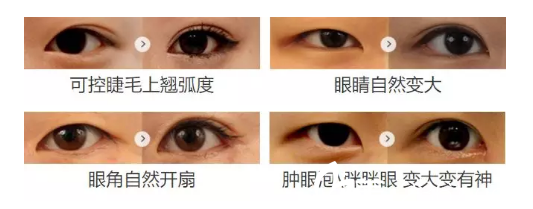 翹睫美瞳術(shù)案例 翹睫美瞳術(shù)案例