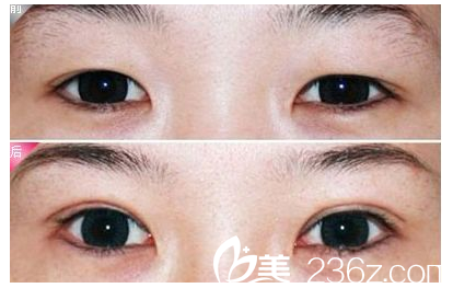 雙眼皮整形案例 雙眼皮整形案例