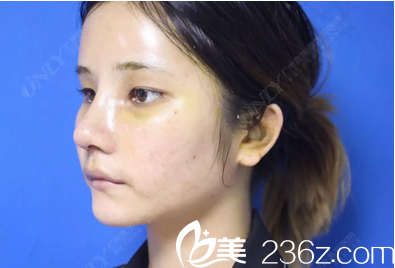 這是找廣州壹加壹張紅艷做玩兩把術(shù)后七天恢復(fù)照片