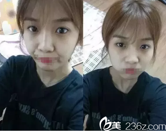 雙眼皮+開眼角+隆鼻術(shù)前 雙眼皮+開眼角+隆鼻術(shù)前