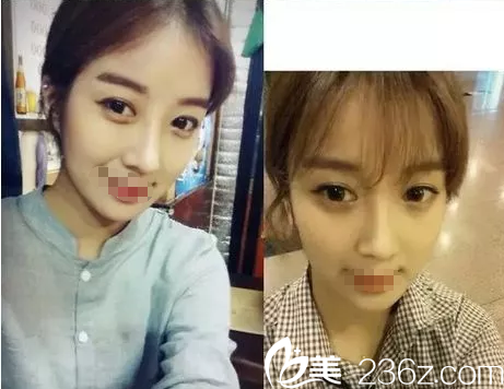 用術(shù)后恢復(fù)過程告訴你為什么雙眼皮+隆鼻我選擇南京維多利亞，沒選整形