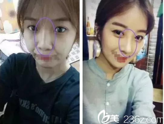 在南京維多利亞做眼鼻整形術(shù)后恢復(fù) 在南京維多利亞做眼鼻整形術(shù)后恢復(fù)