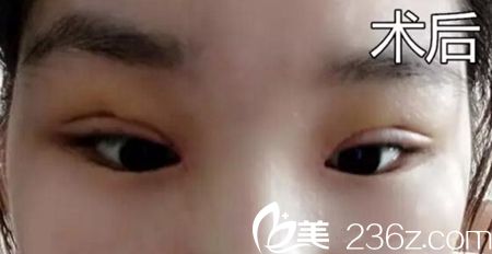 表姐帶我去周口締萊美做雙眼皮修復(fù) 感謝李士成主任挽救了我的失敗雙眼皮