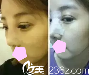 太原華美尹衛(wèi)民醫(yī)生給我做雙眼皮和鼻綜合術后第3天照片 太原華美尹衛(wèi)民醫(yī)生給我做雙眼皮和鼻綜合術后第3天照片