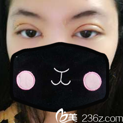 合肥壹美尚切開(kāi)雙眼皮+開(kāi)內(nèi)眼角+祛皮祛脂術(shù)后第3天照片