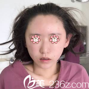 面部填充術(shù)后即刻