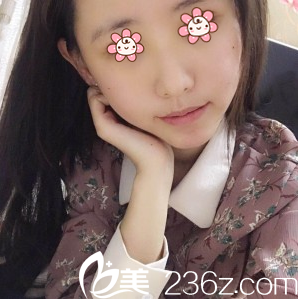 朱紅振自體脂肪面部填充術(shù)后一周