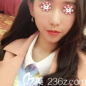 重慶聯(lián)合麗格面部填充術(shù)后11天