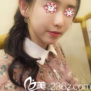 重慶聯(lián)合麗格朱紅振面部脂肪填充術(shù)后19天