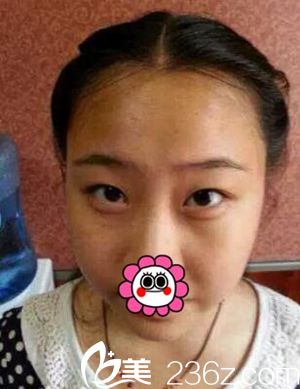 許昌麗娜整形做雙眼皮術(shù)前 許昌麗娜整形做雙眼皮術(shù)前